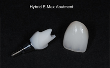 hybrid-emax-abutment