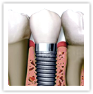 dental implants arizona